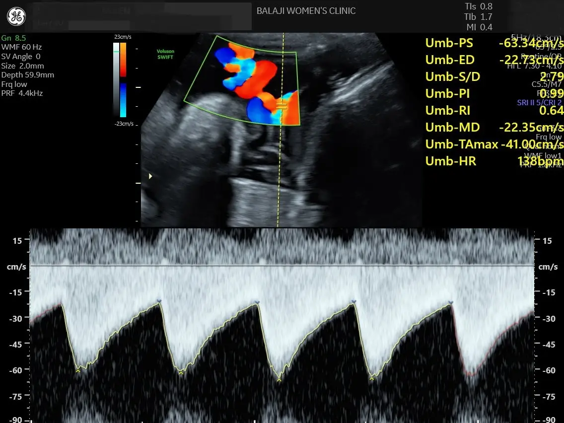 Fetal Doppler Ultrasound Scan